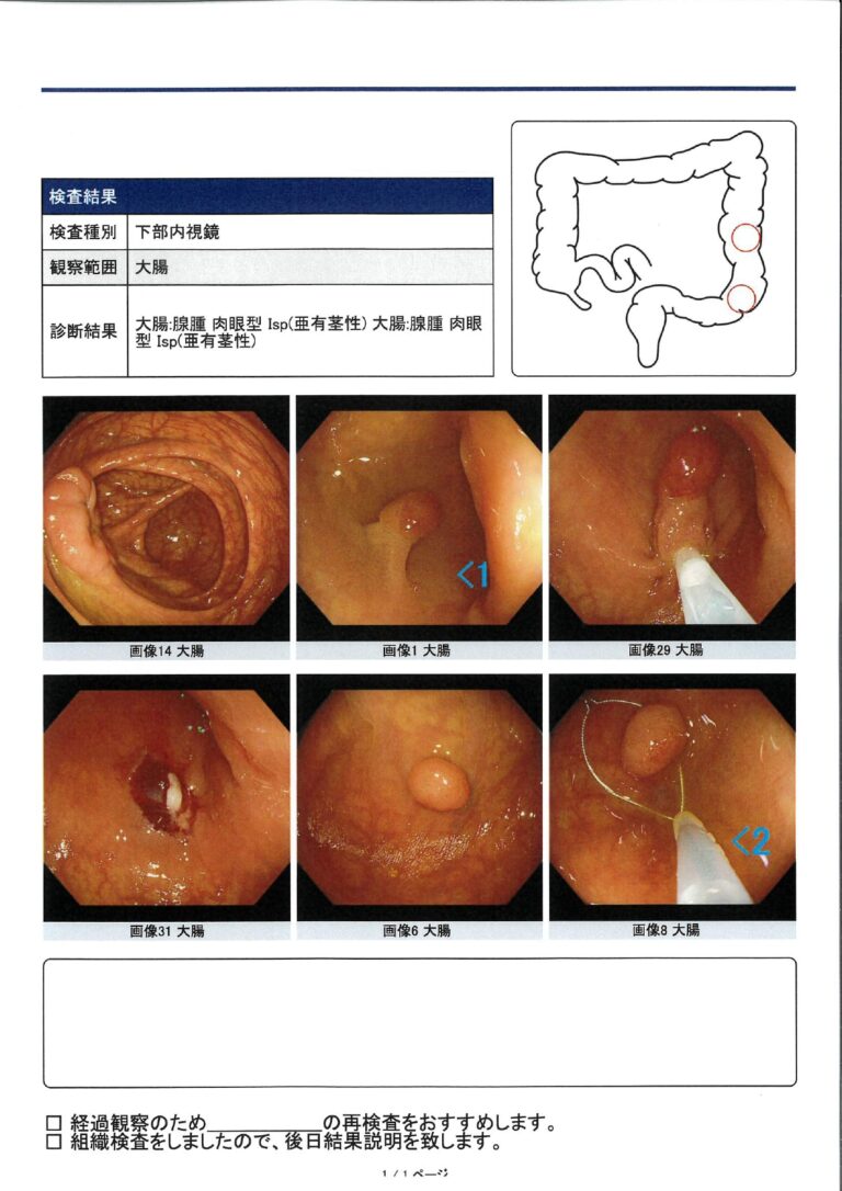 大腸カメラ検査レポート